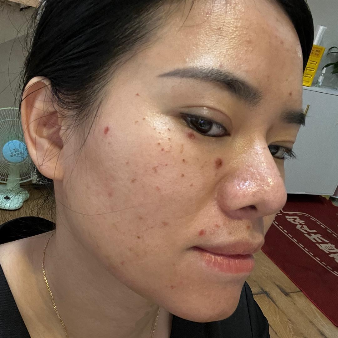 秋秋（祛斑逆袭）