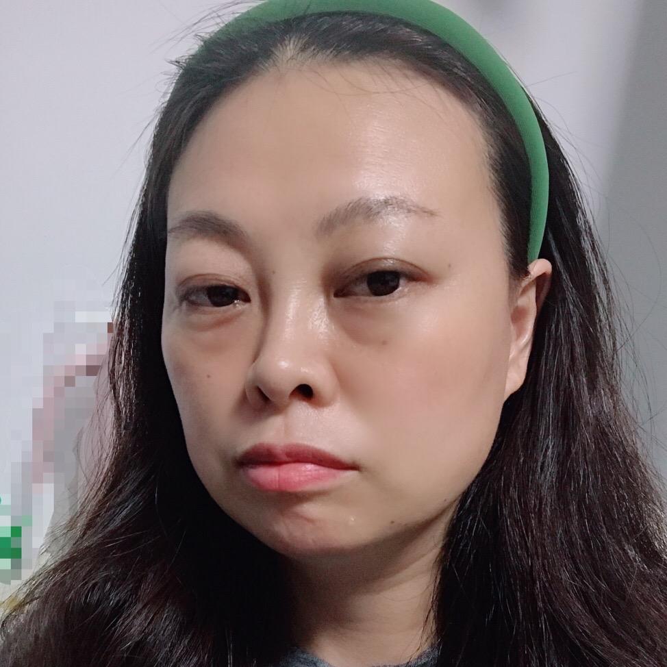 丽姐腰椎骨折康复中