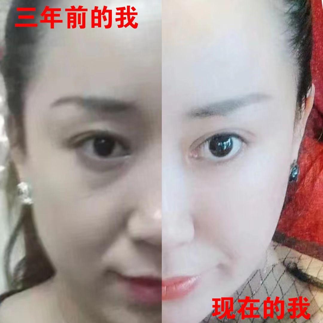 中老年抗衰紧肤秘诀（眼袋，泪沟，法令