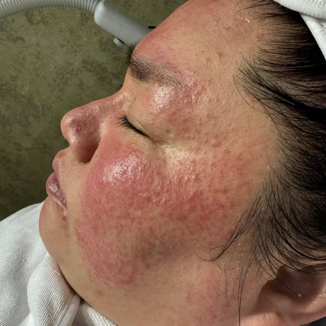 200斤大红脸痘敏修护日记