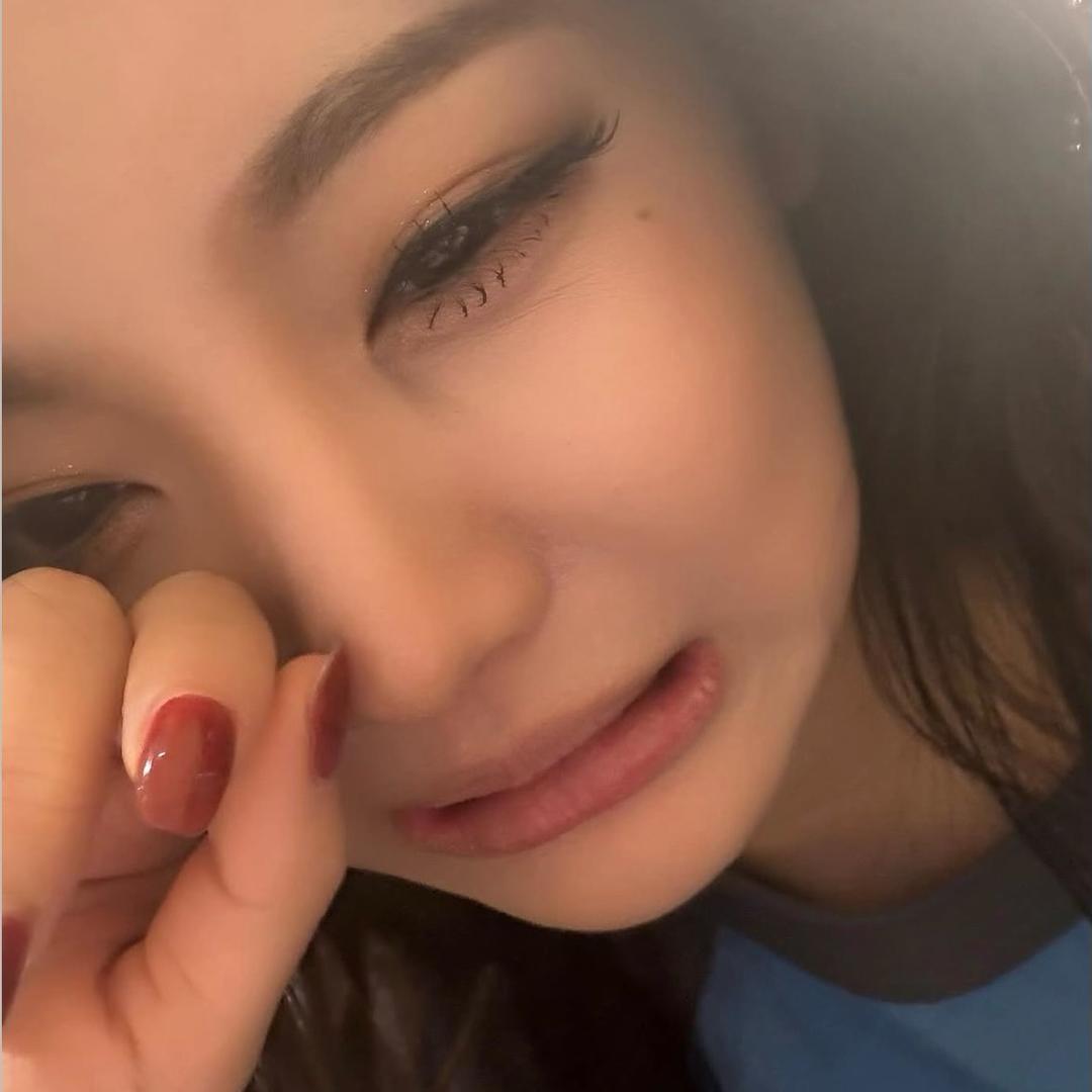 黑眼圈