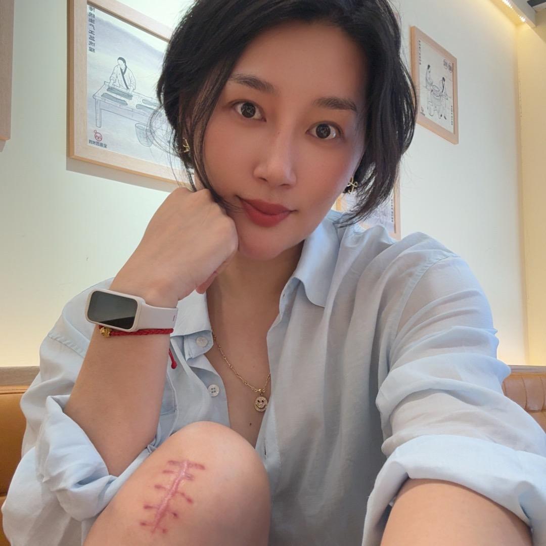 绵绵（胫腓骨、后踝骨折）