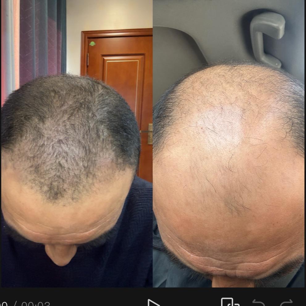 闫先生的生发之路