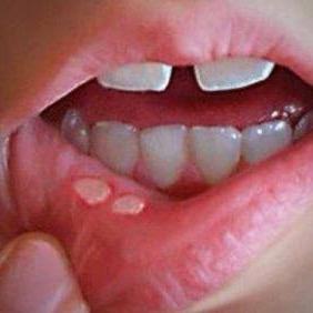 口腔溃疡滚滚滚