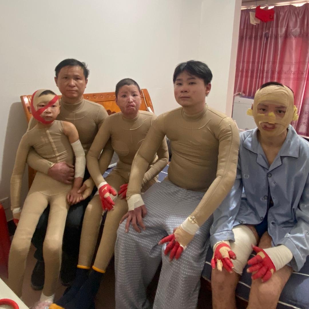 烧伤一家五口吴玲玉