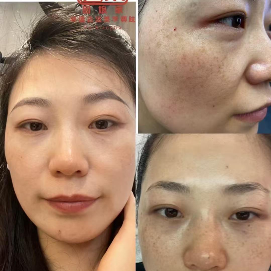 麻子变凤凰