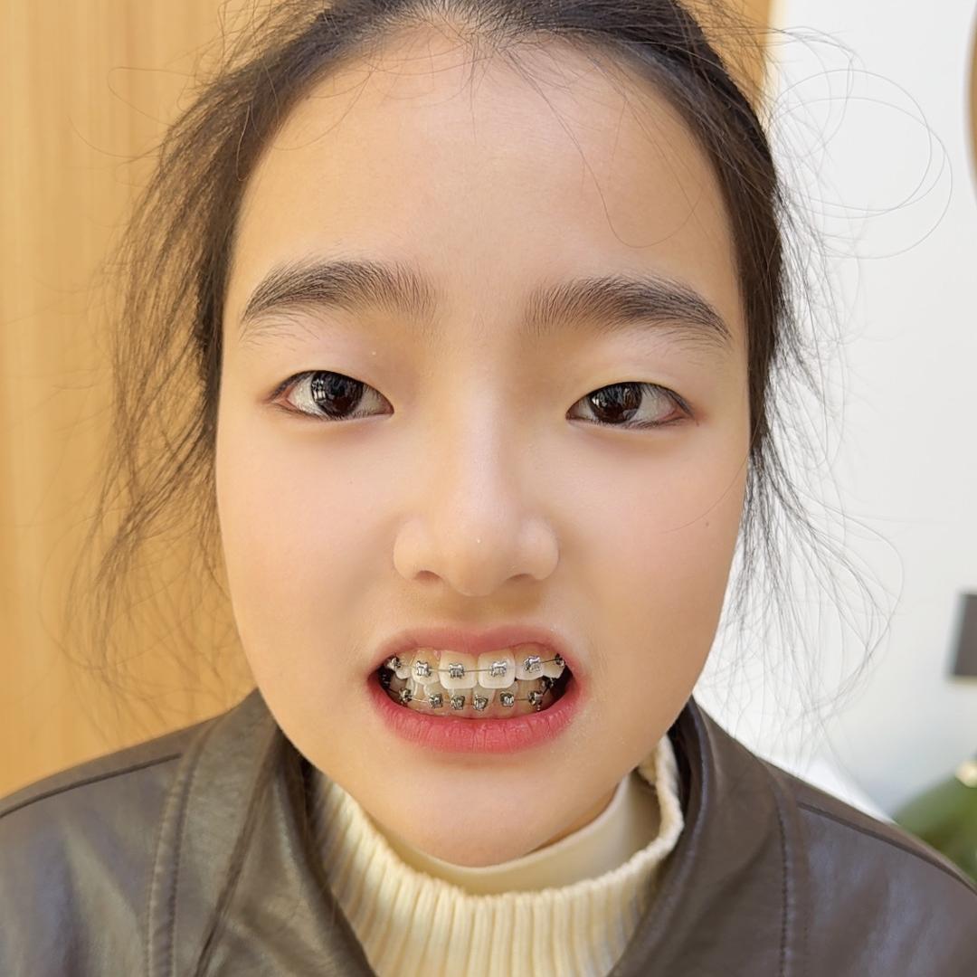 萌萌牙套版@百货