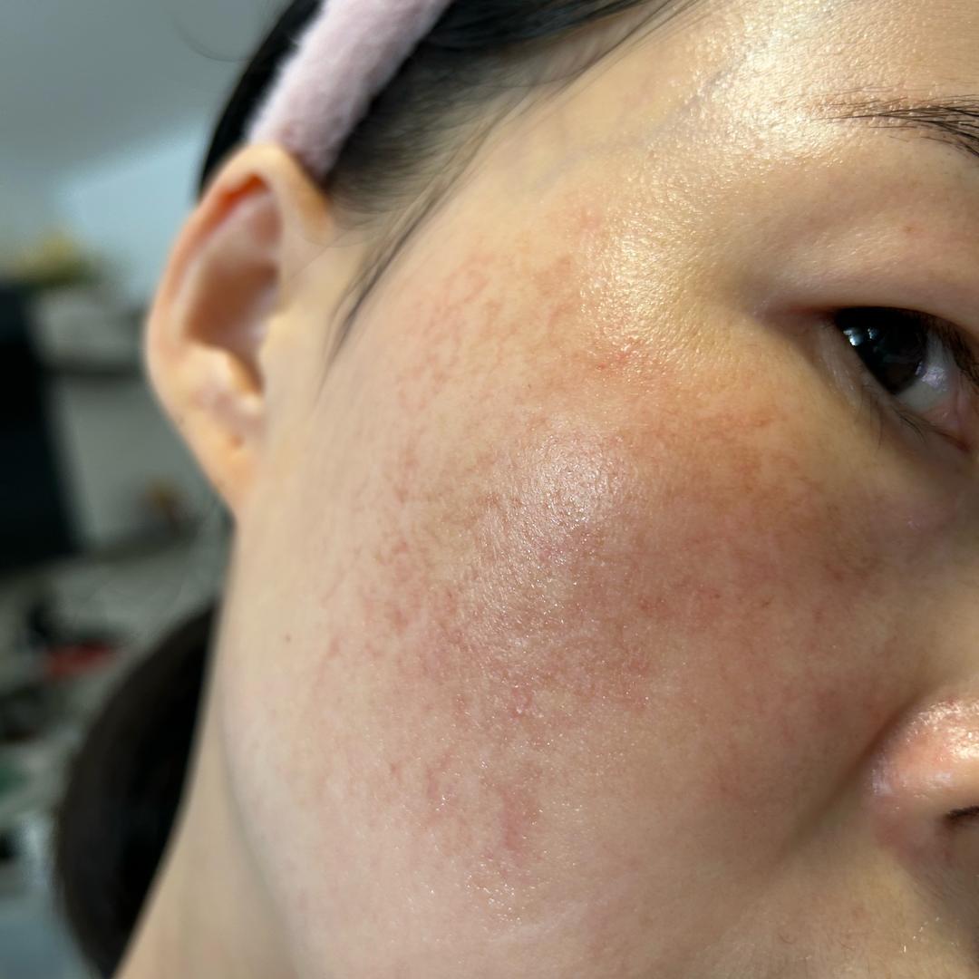 烂脸的丹丹～脸好了