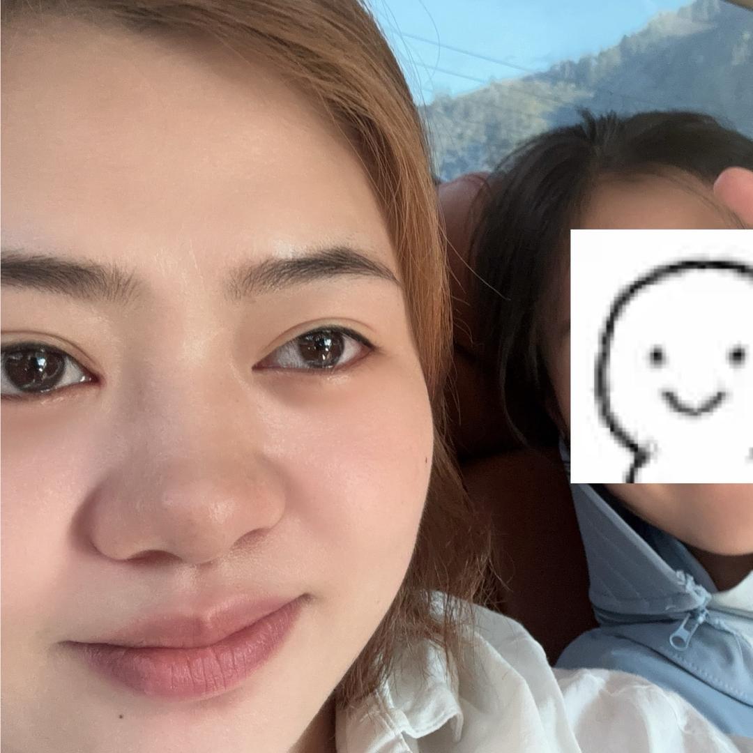 阿莹（溃疡性结肠炎）