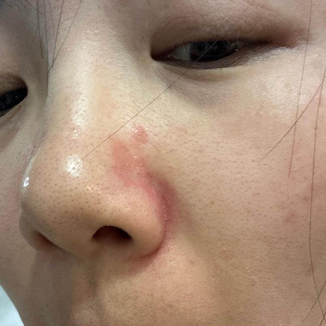 钕王【脂溢稳定中】