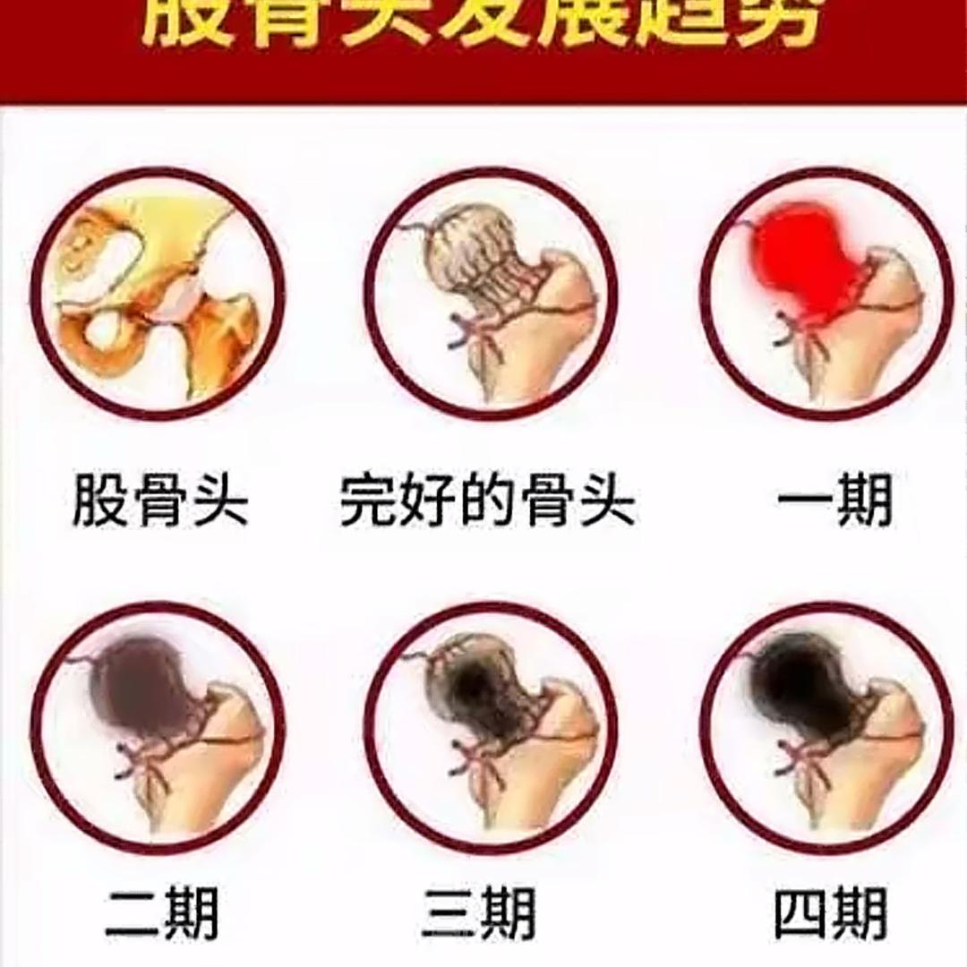 股骨头保守—金