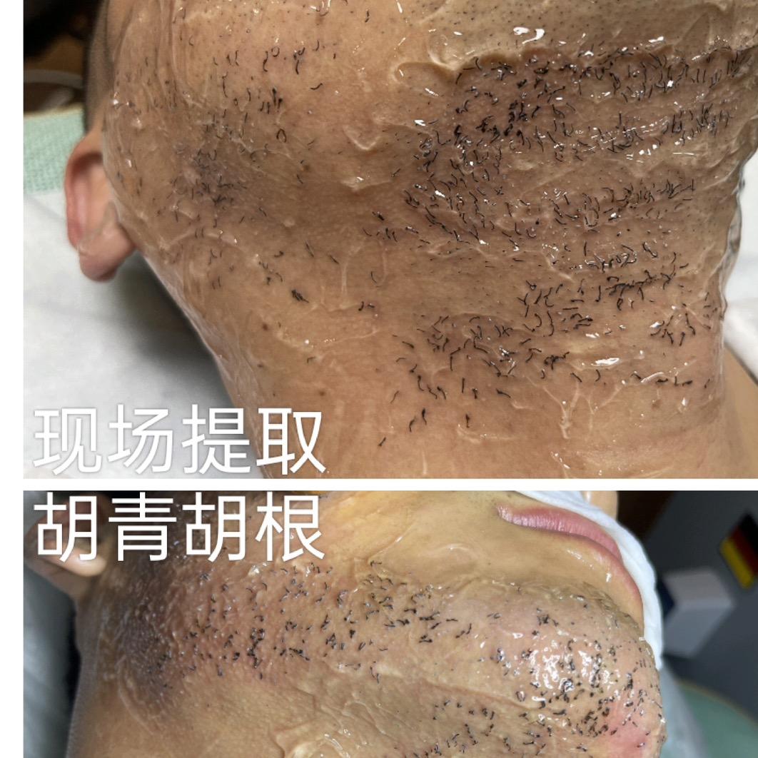 武陟县北斗星男士胡须（根除中心）