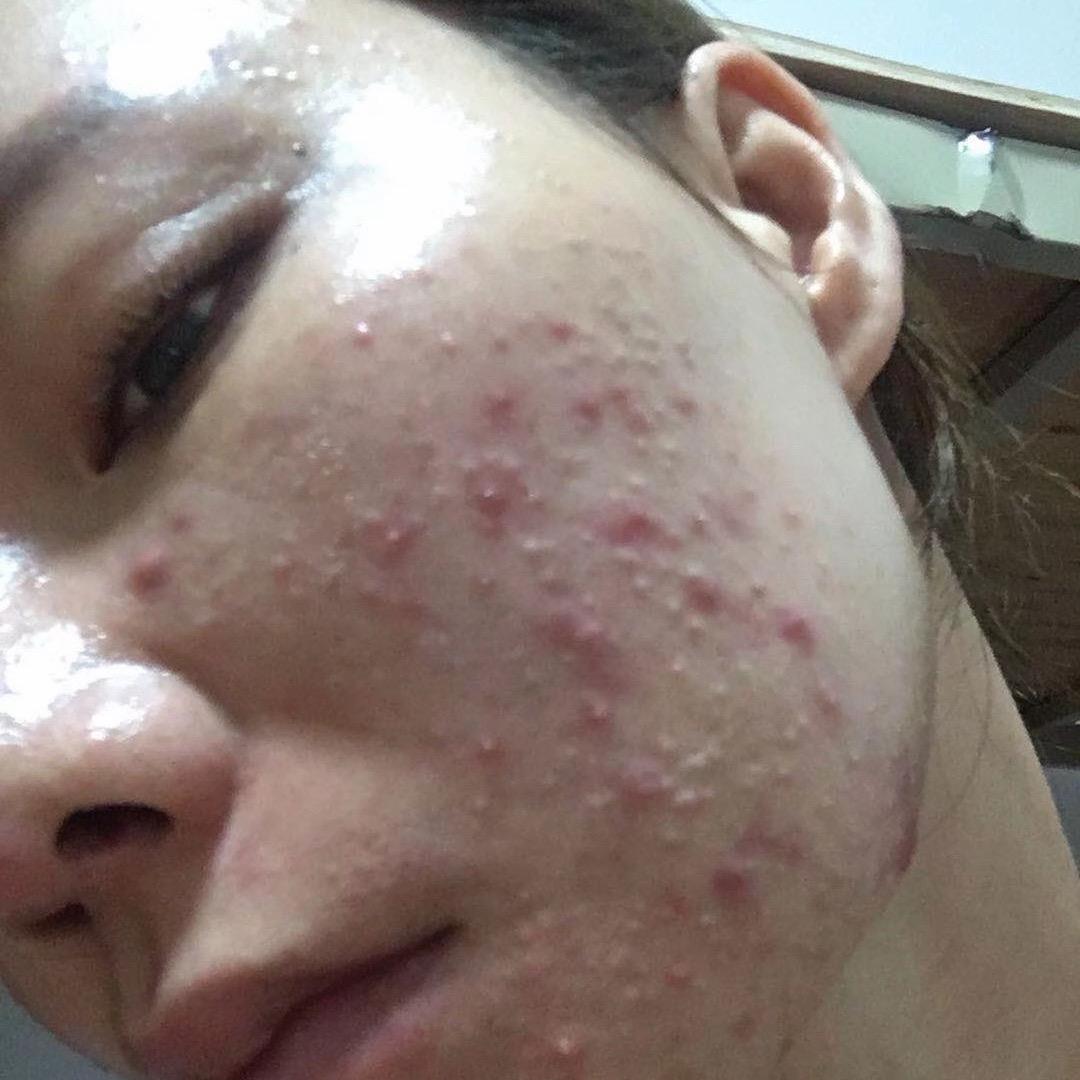 草本熬煮（专注问题肌）