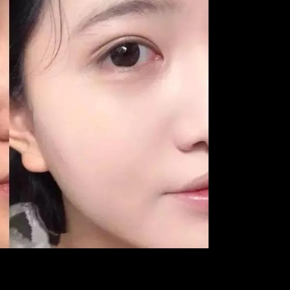 大亚湾点痣点班袪班