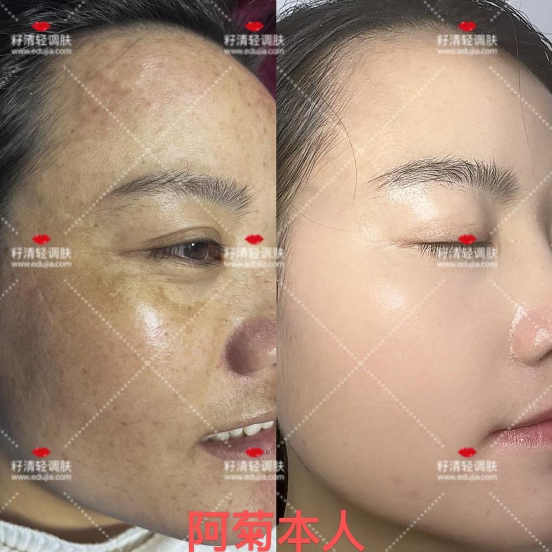 阿菊的皮肤逆袭之路