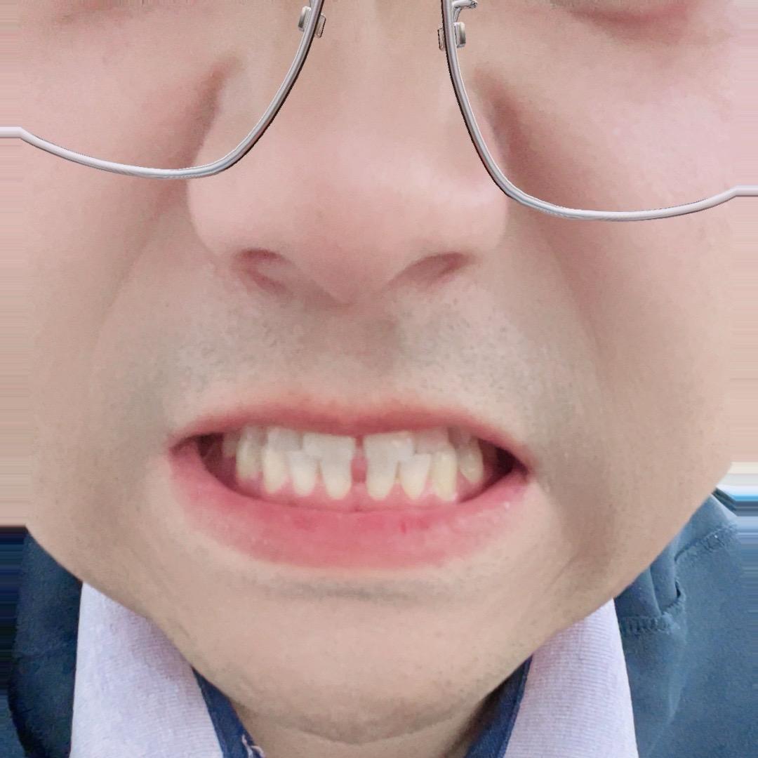 大牙缝