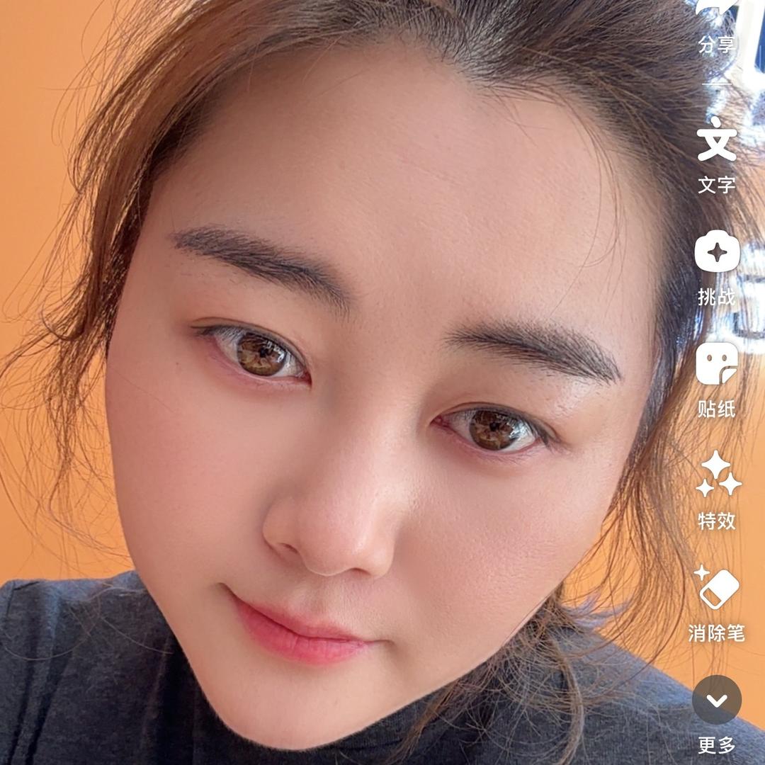 在灌云做点痣点斑的小郑郑