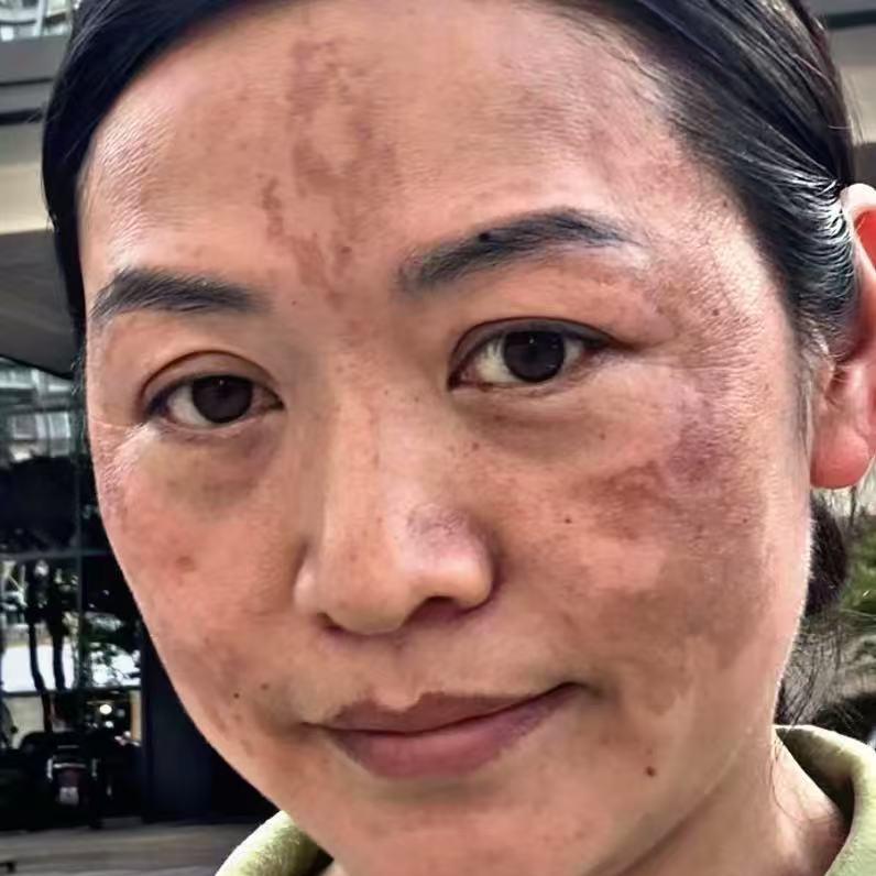 岚岚问题肌管理