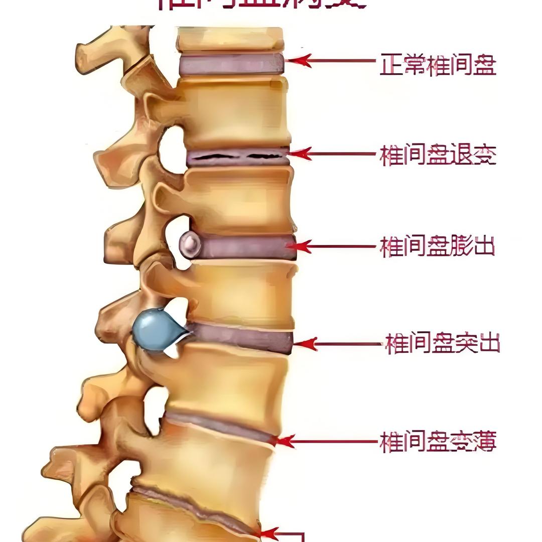 脊椎腰椎治疗