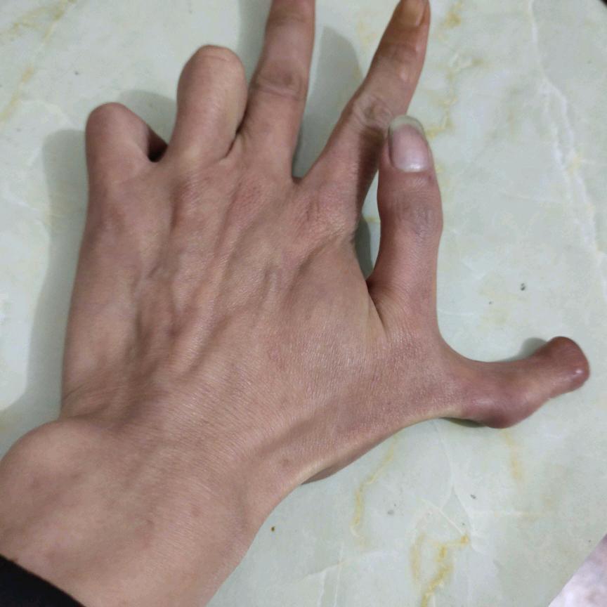 六指小哥