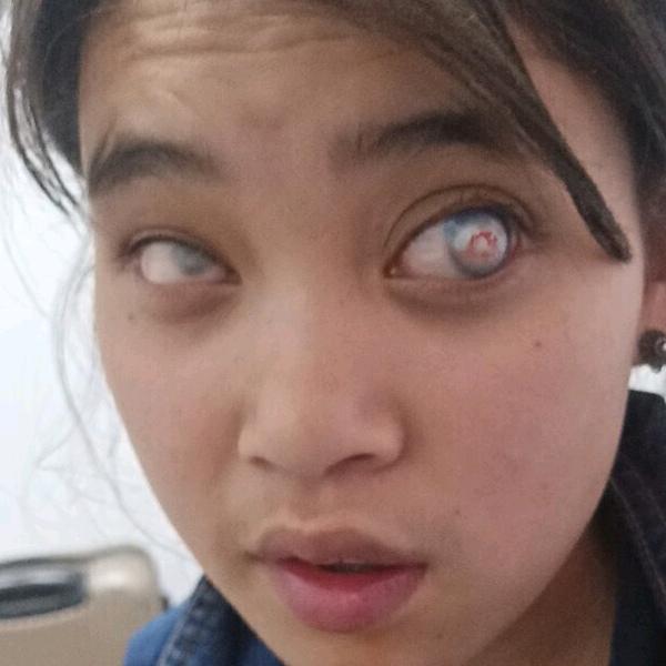 残疾人阿恩古子