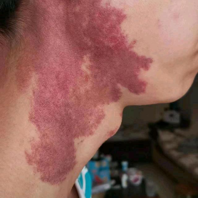 南阳现代专业非手术去除凸凹疤痕
