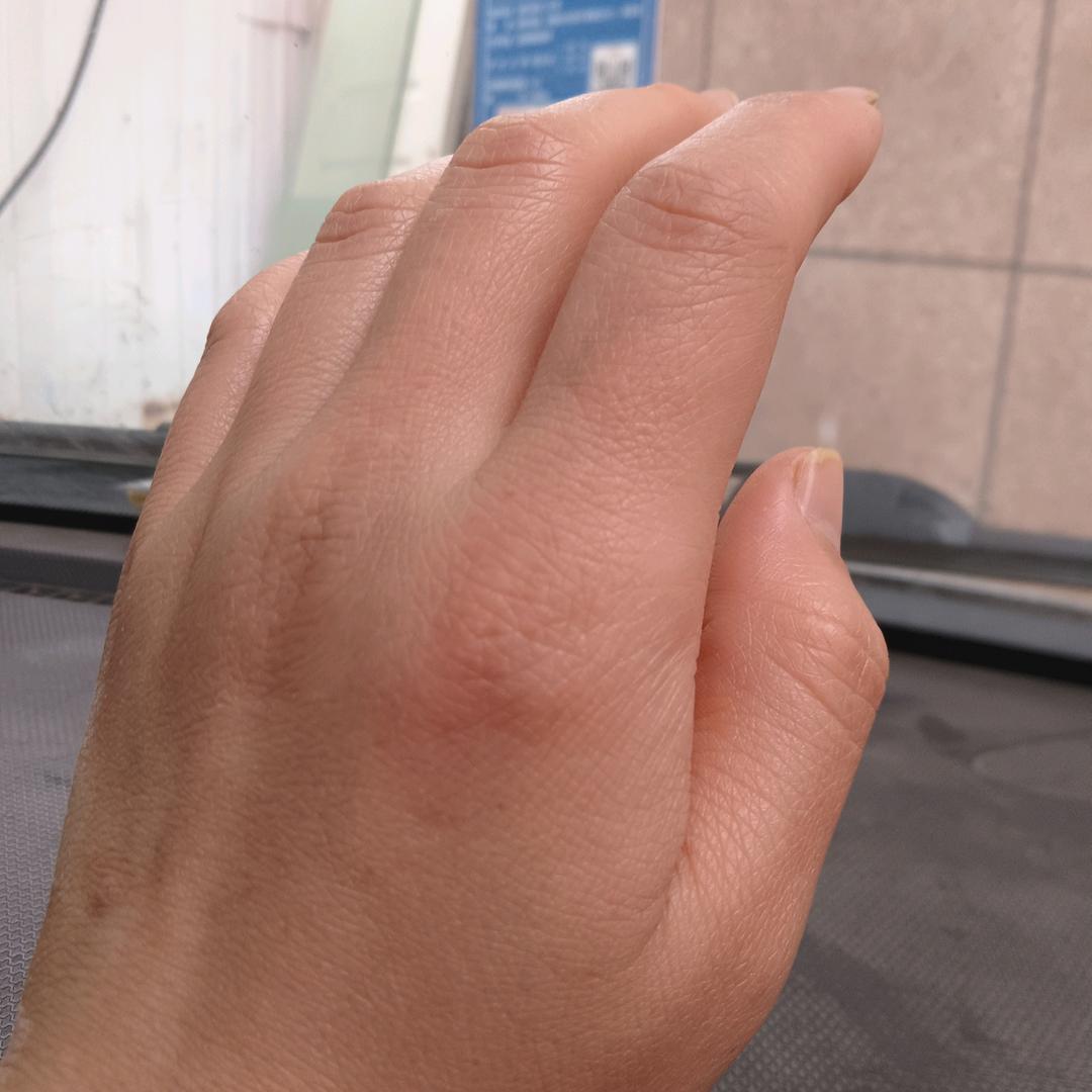 干燥综合征+系统性红斑狼疮患者❤️