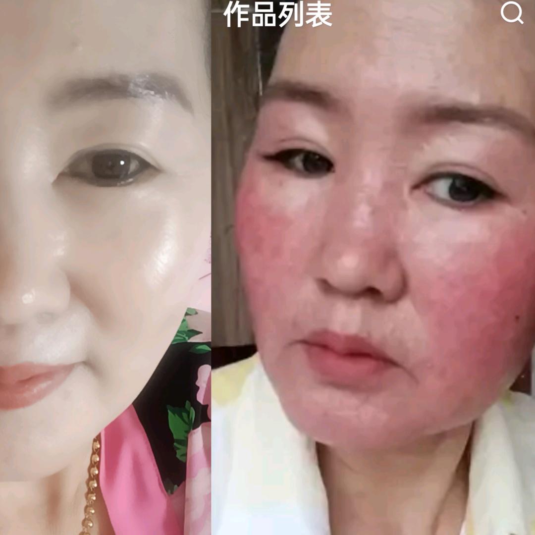 芳芳激素脸