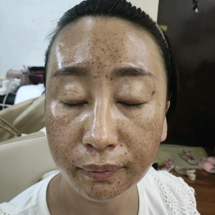 麻麻蜕变记（皮肤修复中）