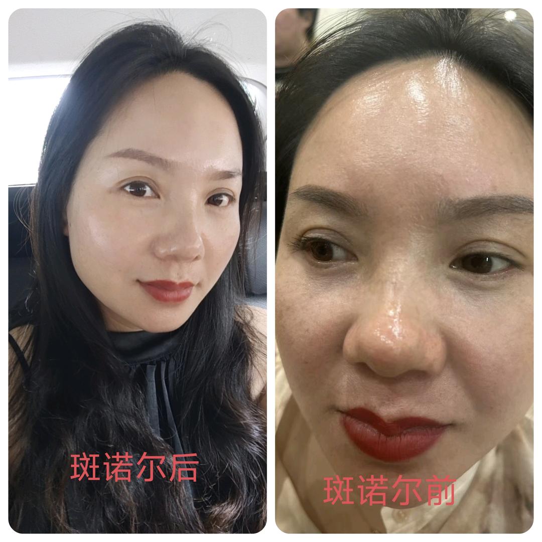 U3调肤解决斑痘敏