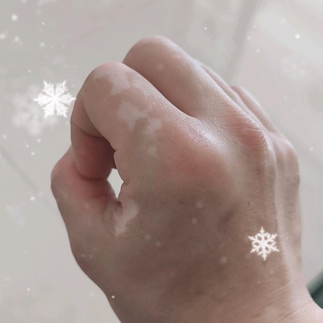 白癜风患者，找工作被嫌弃