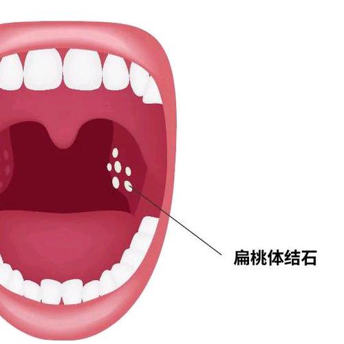 含胸驼背