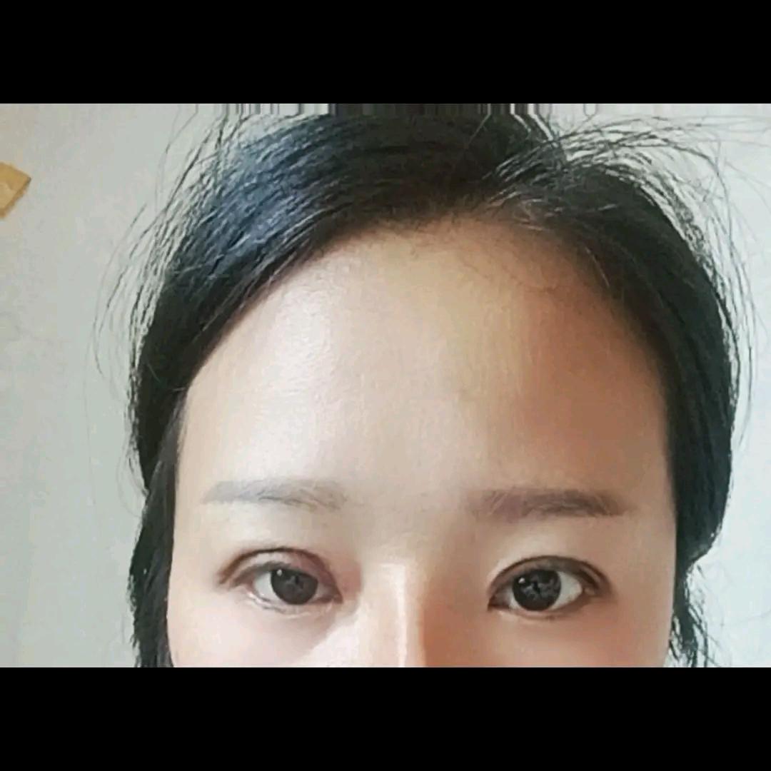 双眼皮修复记录