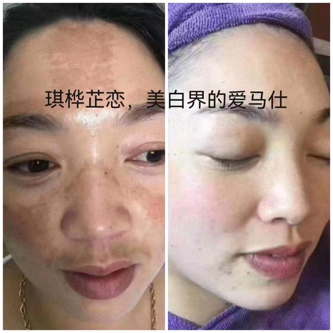 琪桦芷恋（化妆品）强效淡斑去秀红血丝！