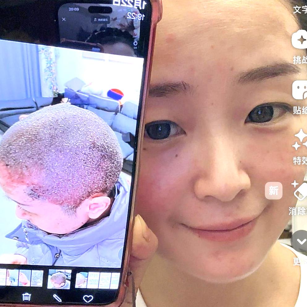 莫离银屑病自愈中