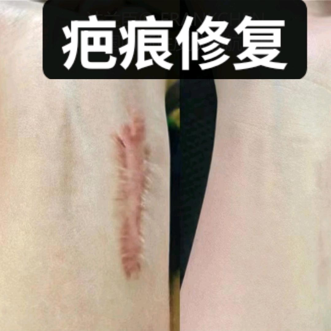 疤痕疙瘩