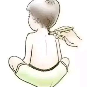 张国庆西安儿推艾灸