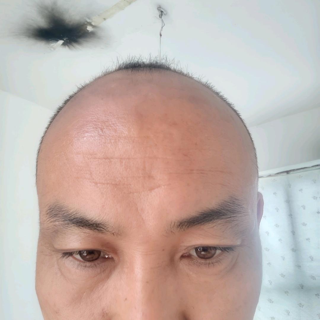 脱发15年(徐峰指导）