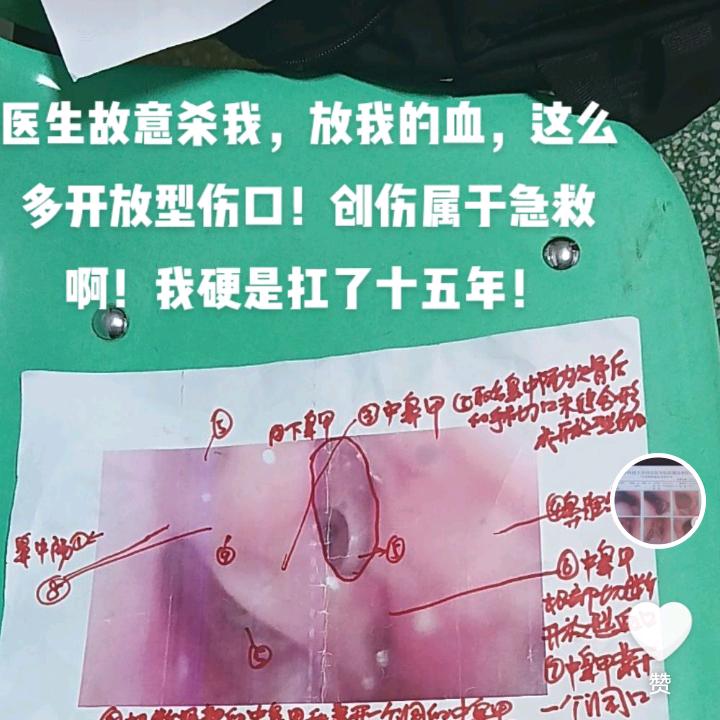 邓冈如置顶图中那么做鼻手术是故意杀人