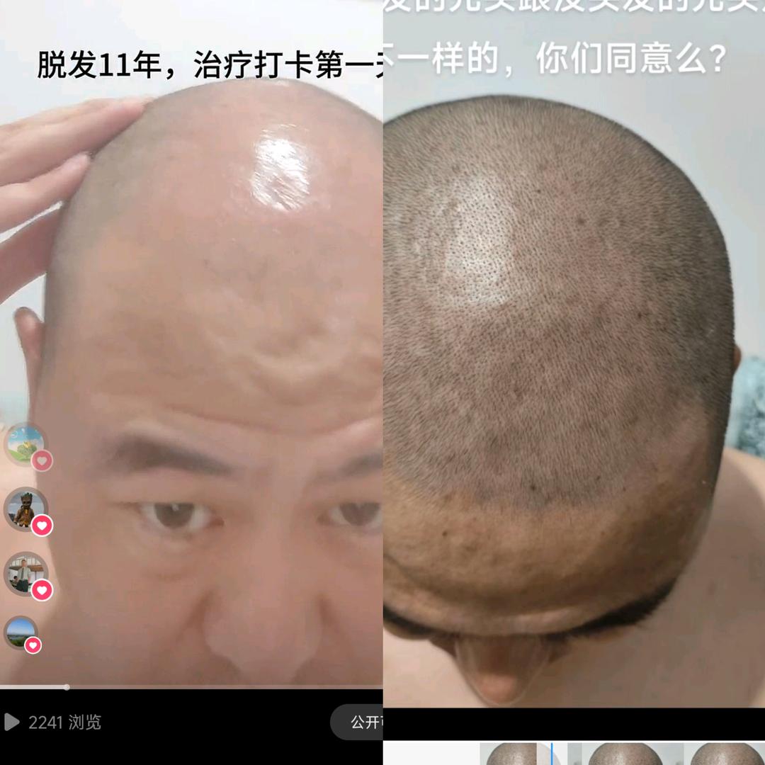 杨老二（地中海七级脱发）1