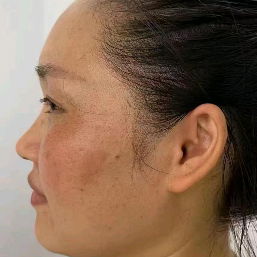 零下斑计划，在祛斑的路上