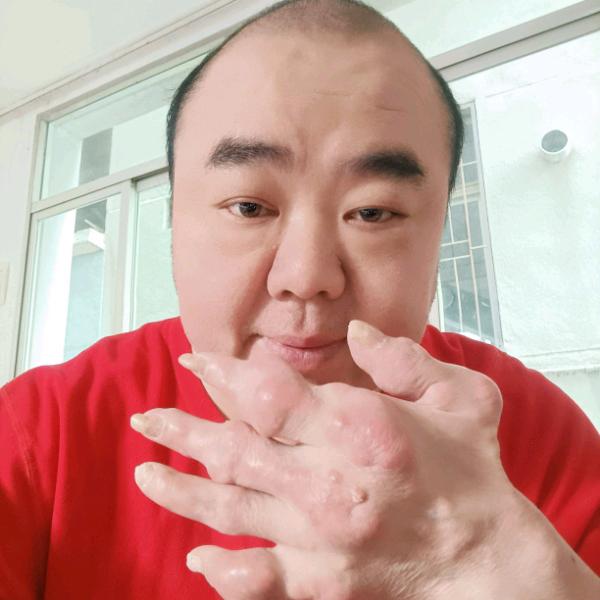 感恩前行-26年痛风路