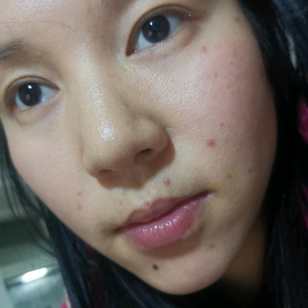 记录点痣