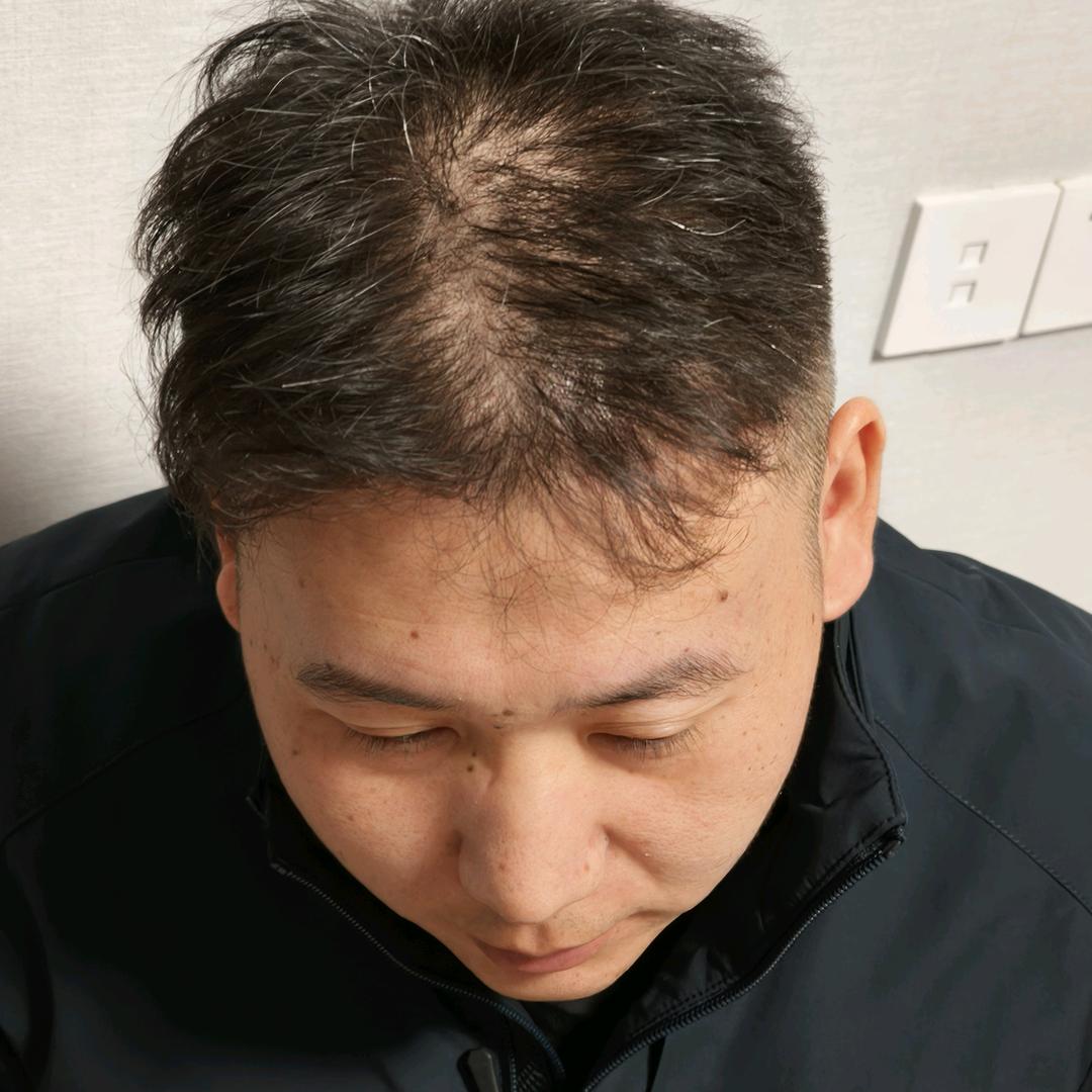 脱发小朱