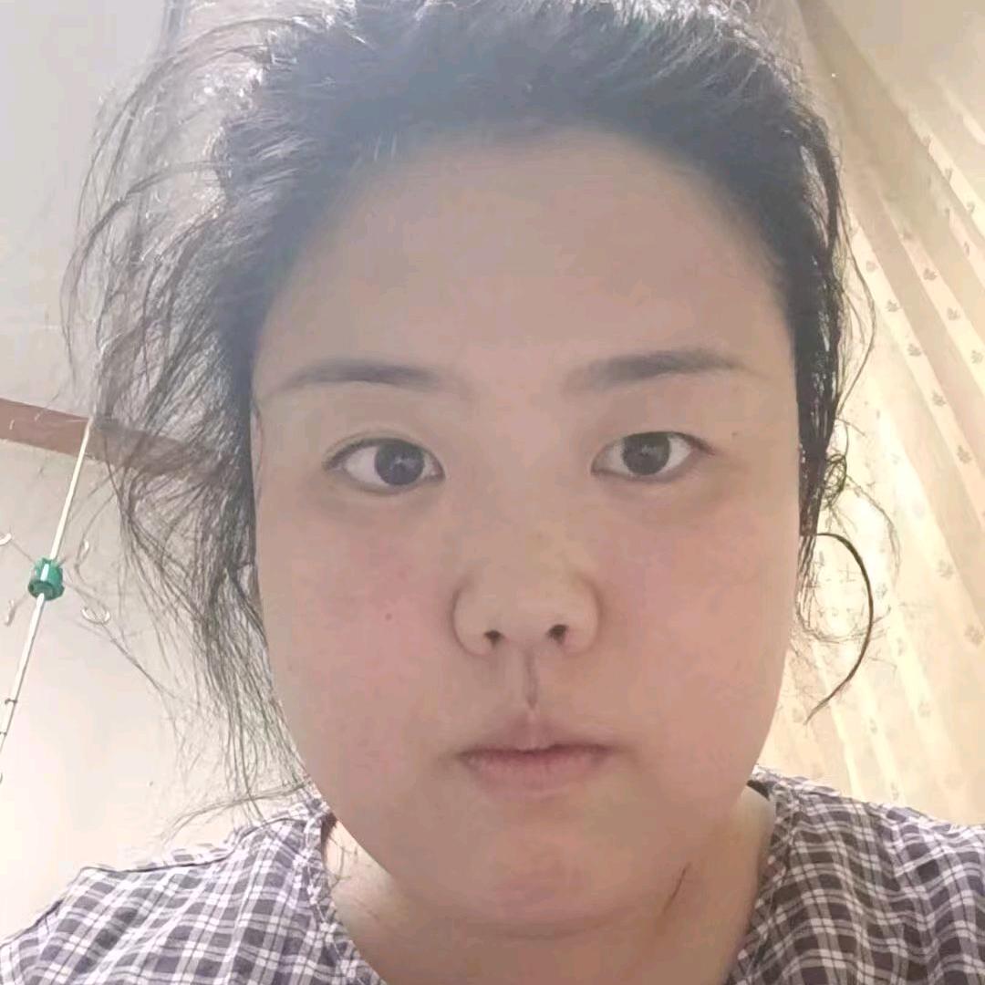 阿娇之狼疮逆袭之路