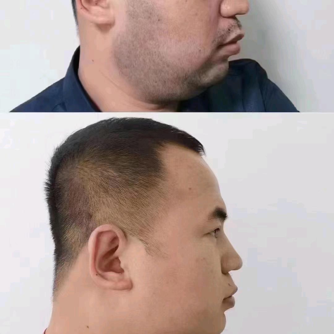 兰州晓慧根除黑白大胡子