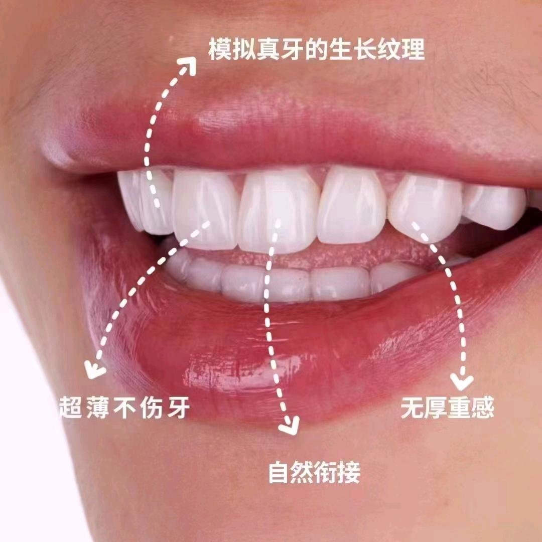 阿哲全瓷树脂美牙