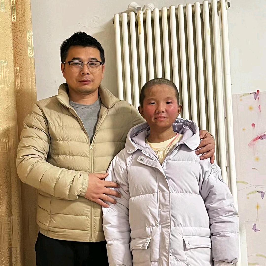 第二次骨髓移植