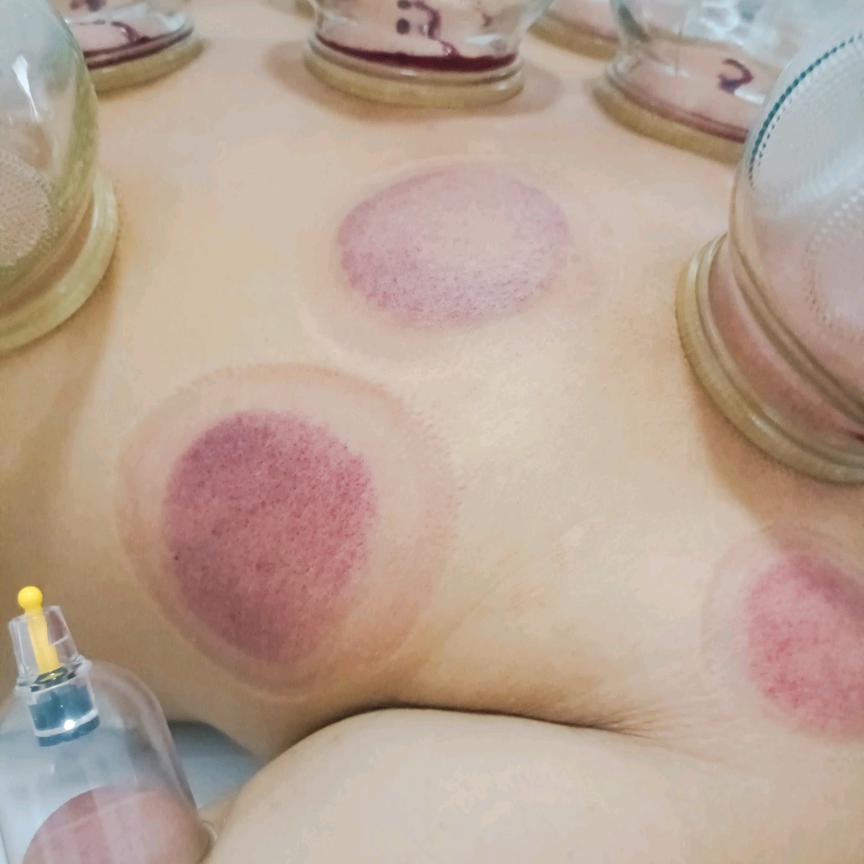 拔罐按摩
