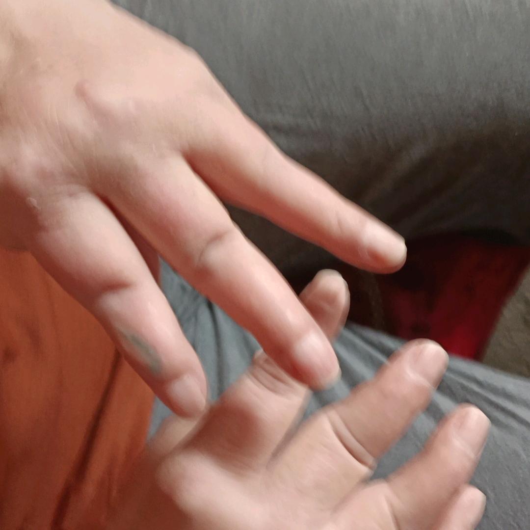 类风湿股骨头坏死、半月板损伤、各种疑难杂